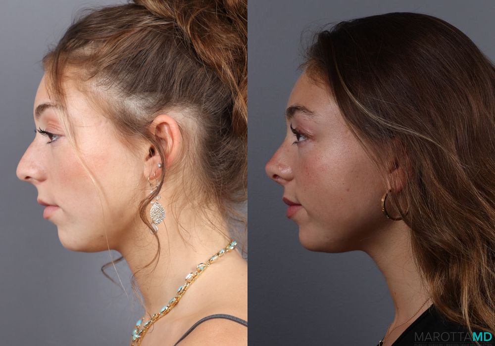 Before and after Rhinoplasty case 7264 - Angle 3
