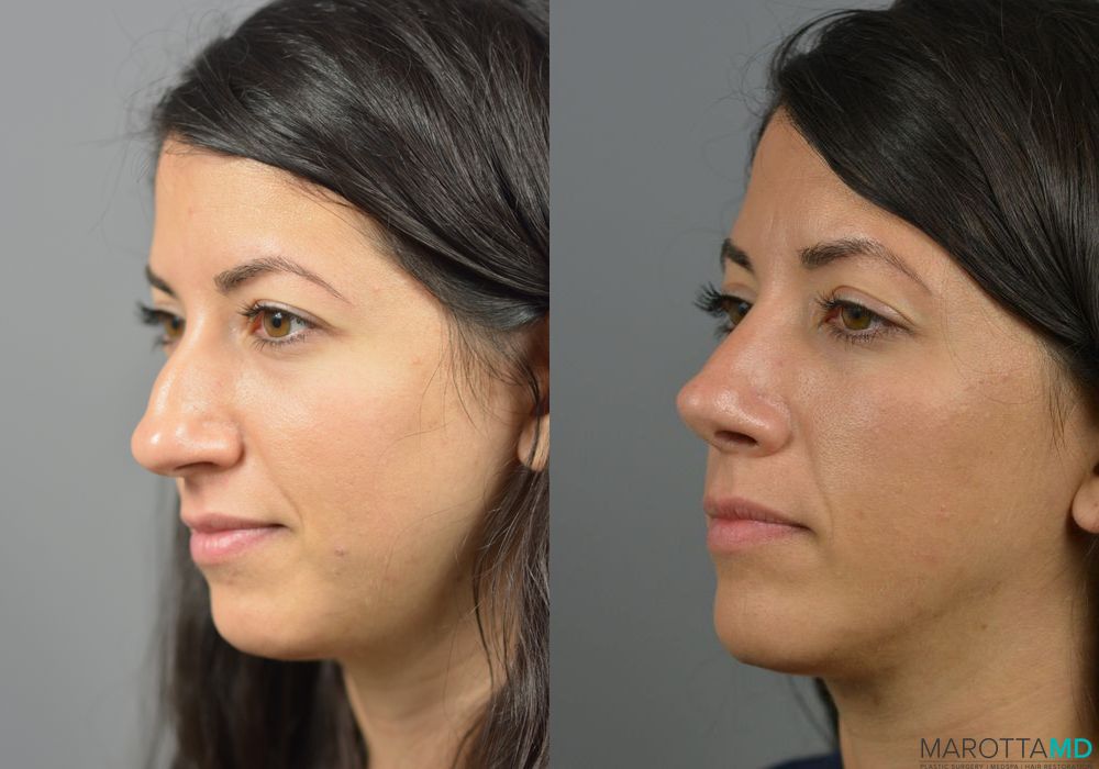 Rhinoplasty - Thumbnail 4