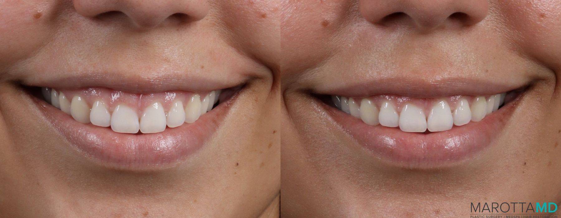 Before and after Botox - Gummy Smile case 7256