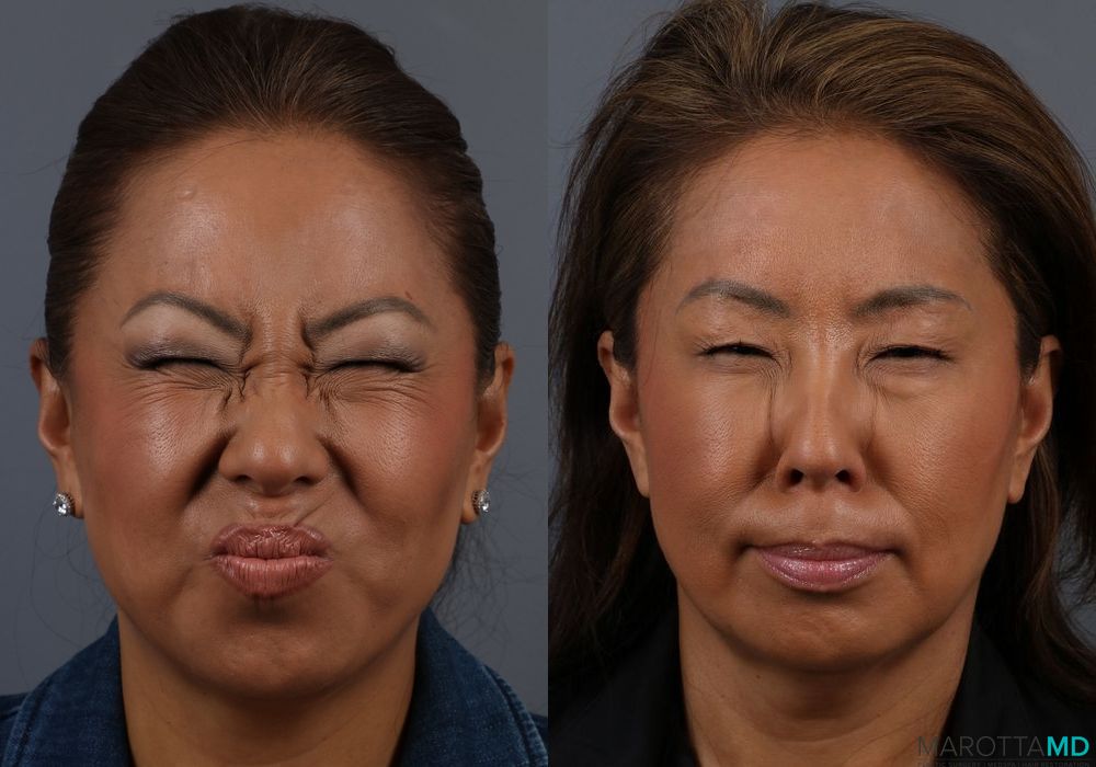 Botox - Glabella - Thumbnail 2