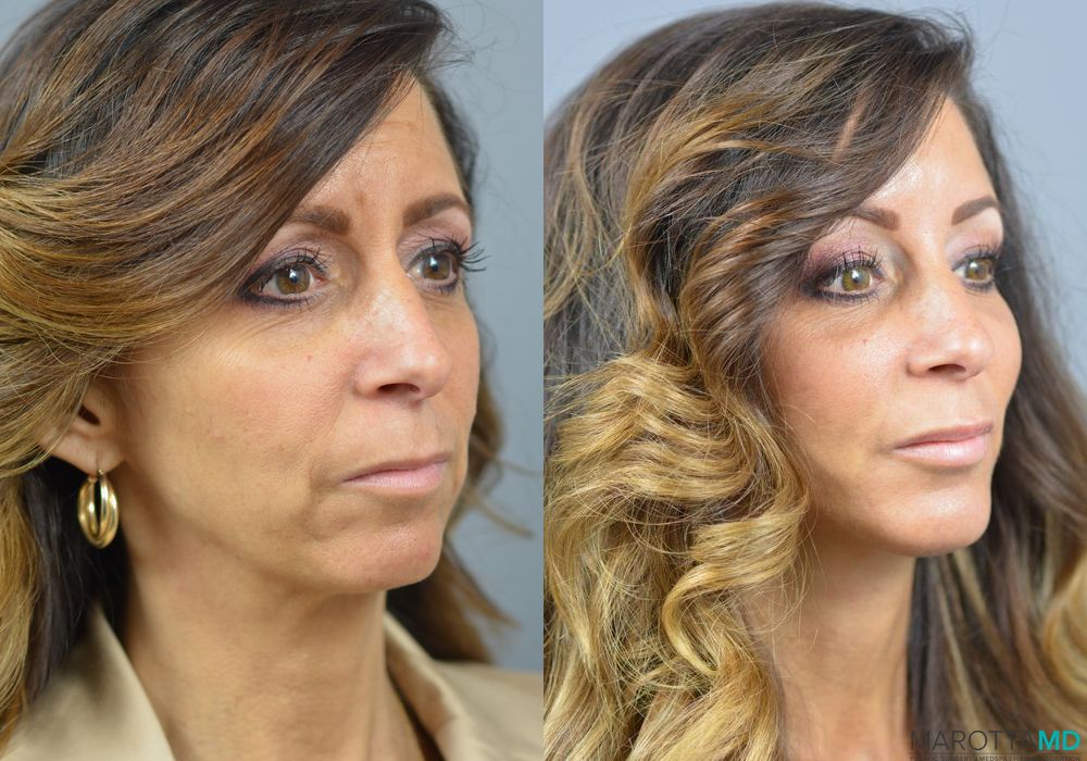 Chin Implant - Thumbnail 3