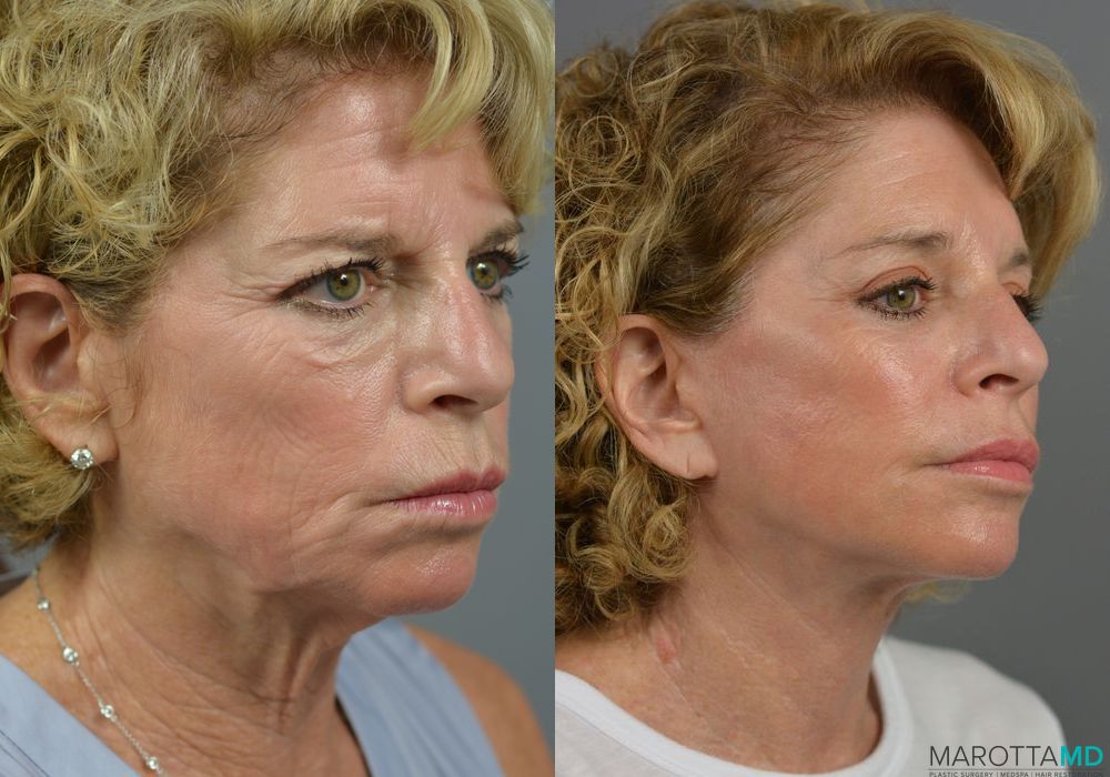 Brow Lift - Case 173