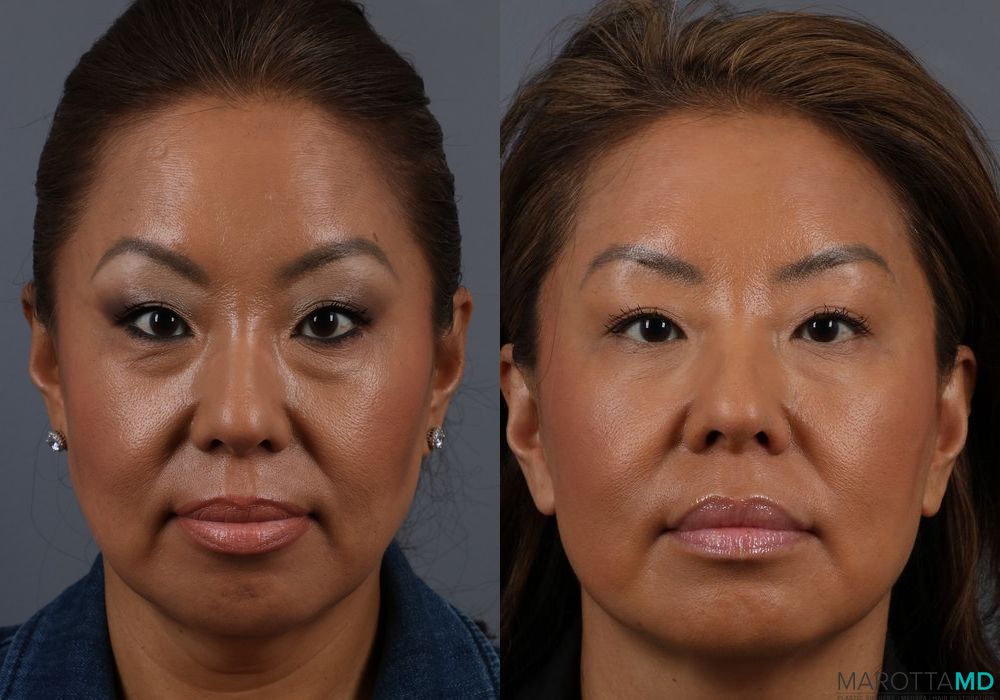 BOTOX® Cosmetic - Case 381