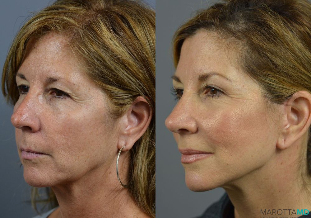 Before and after Fat Transfer - Face case 7255 - Angle 4