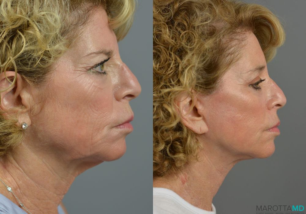 Endoscopic Brow Lift - Thumbnail 2