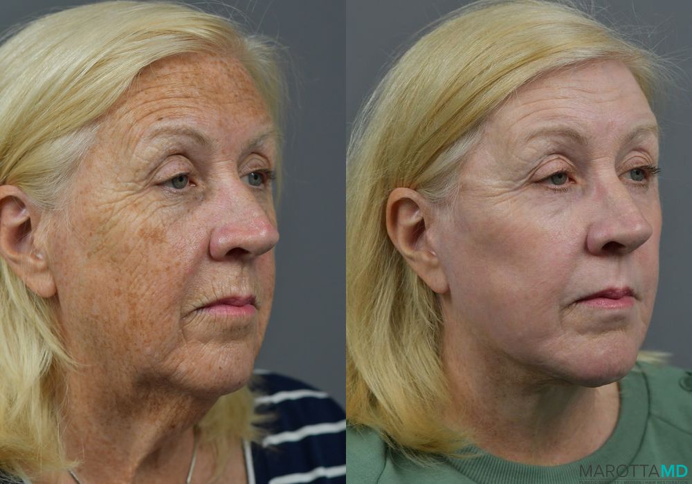 Laser Skin Resurfacing - Face - Thumbnail 4