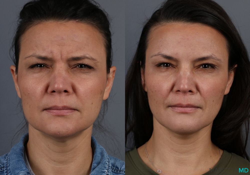 Before and after Botox - Forehead case 7156 - Angle 2