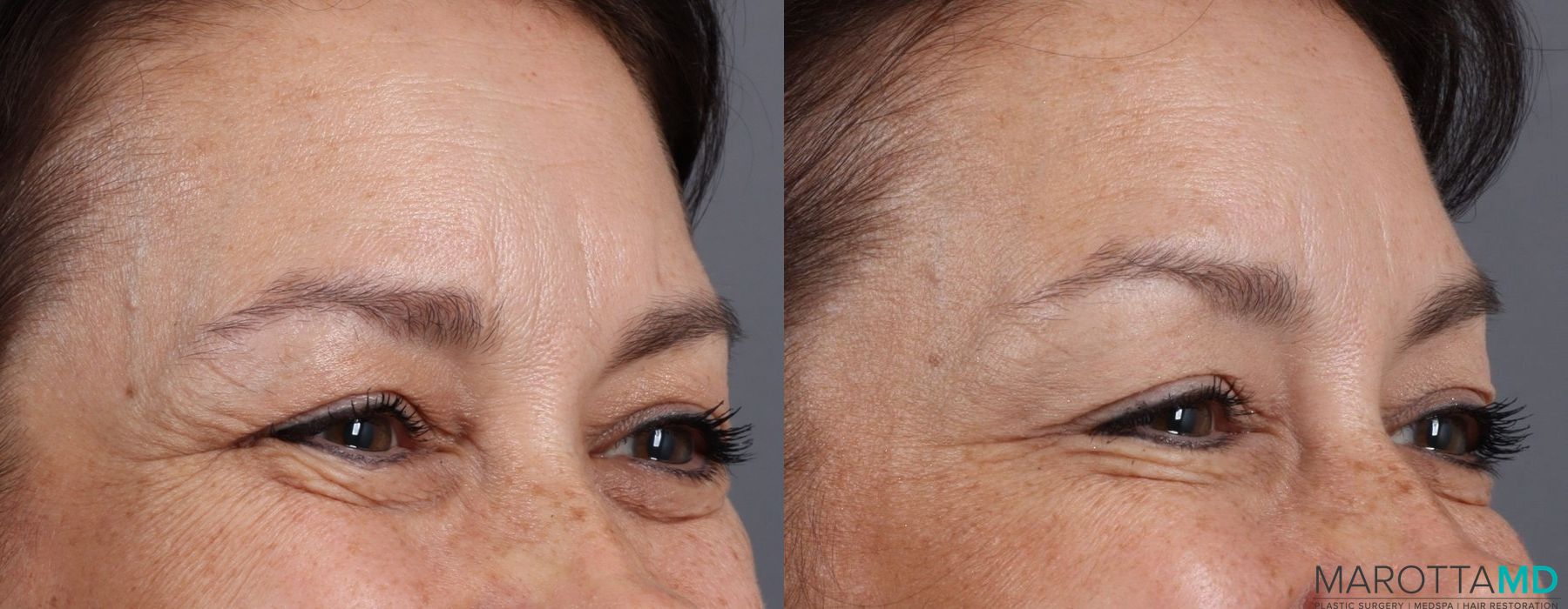 Botox - Crow's Feet - Thumbnail 2