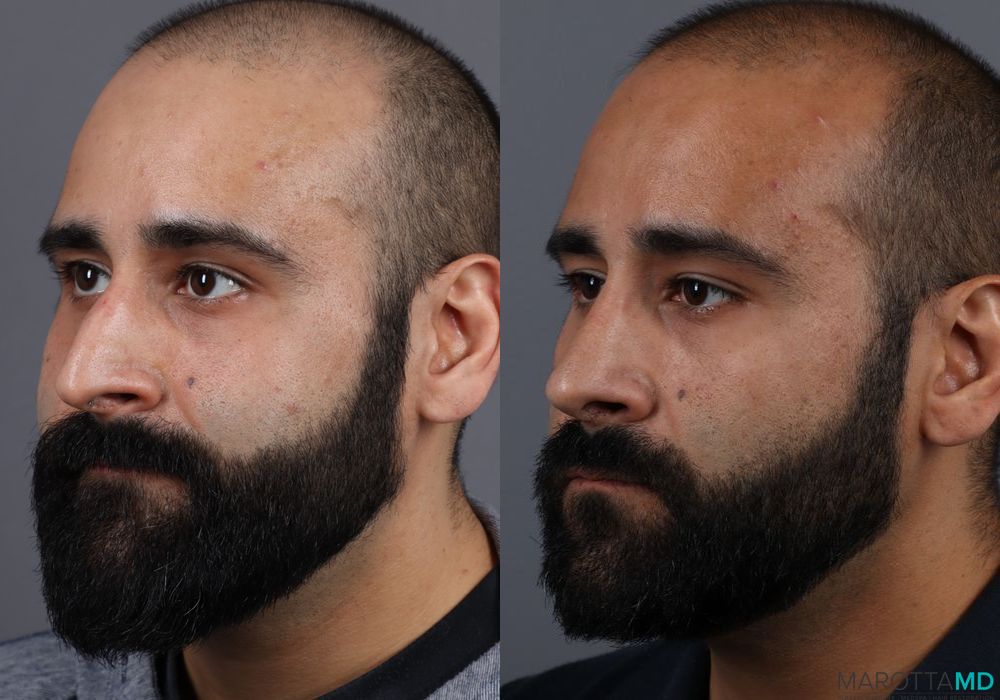 Before and after Male Rhinopolasty case 7261 - Angle 4