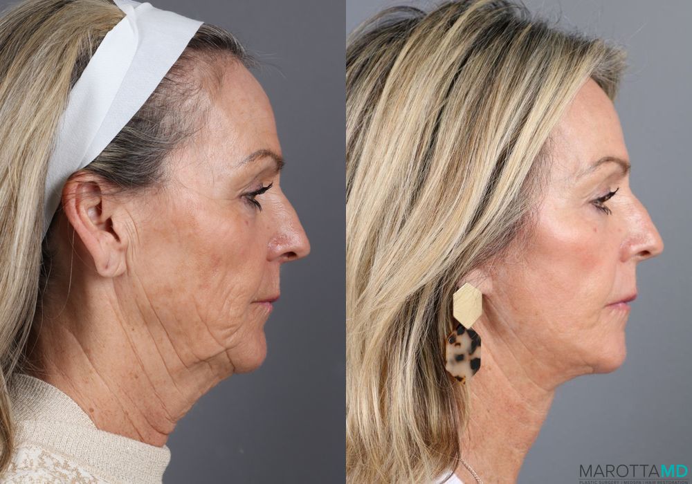 Laser Skin Resurfacing - Face - Thumbnail 4