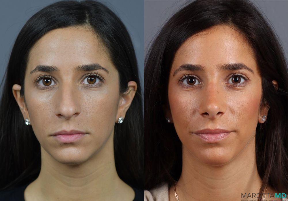 Before and after Rhinoplasty case 7278