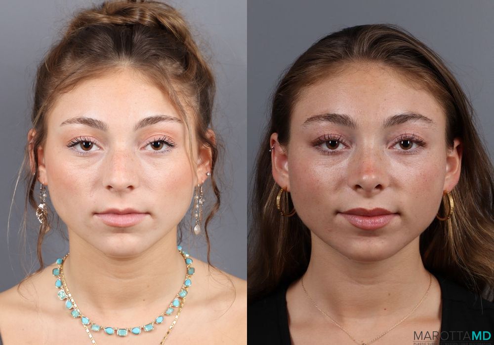 Before and after Rhinoplasty case 7264