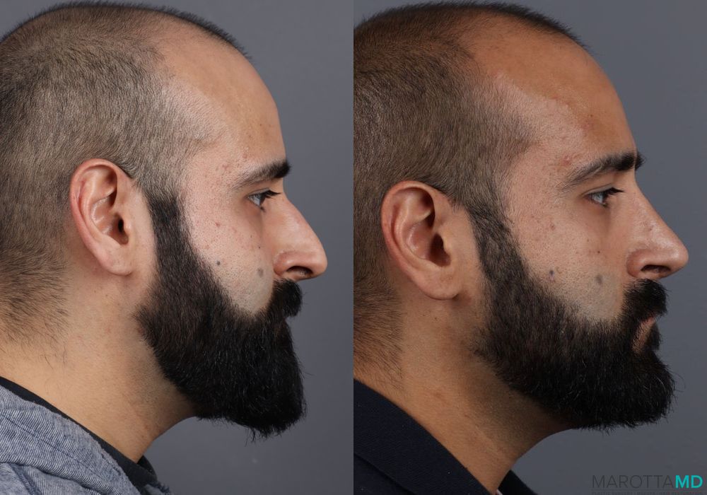 Before and after Male Rhinopolasty case 7261 - Angle 3