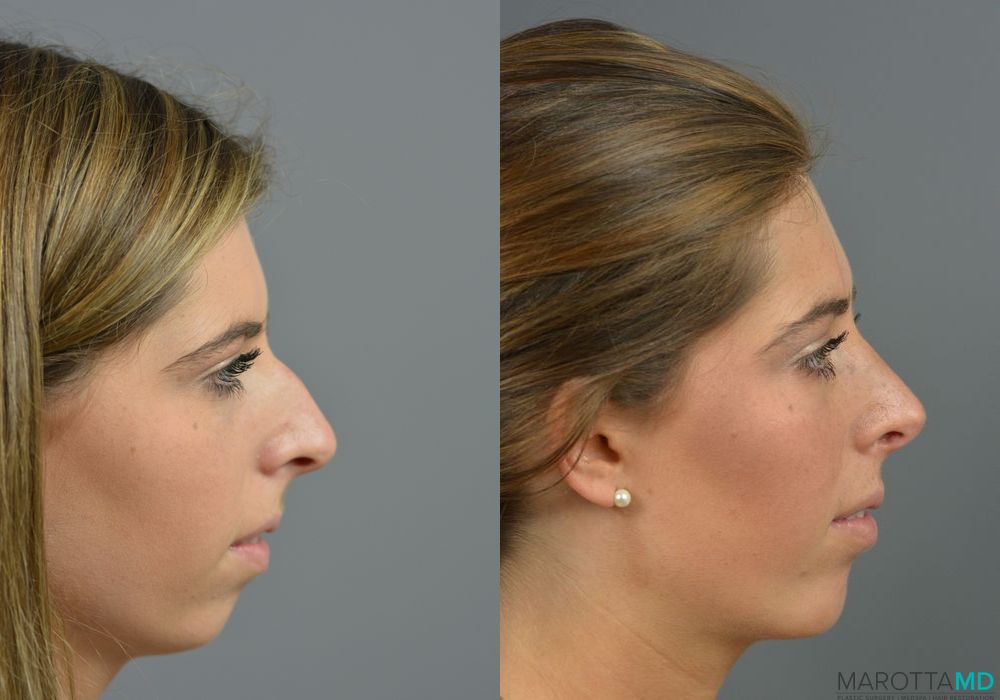 Rhinoplasty - Thumbnail 3