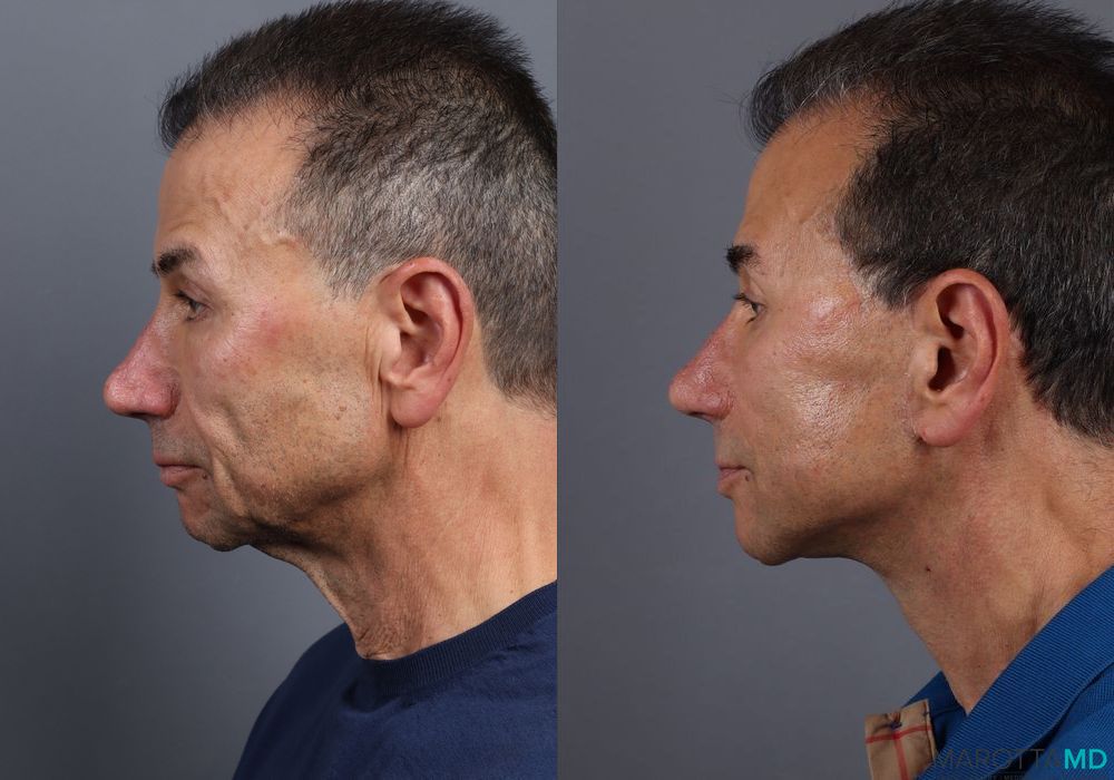 Before and after Facelift & Neck Lift case 7115 - Angle 5