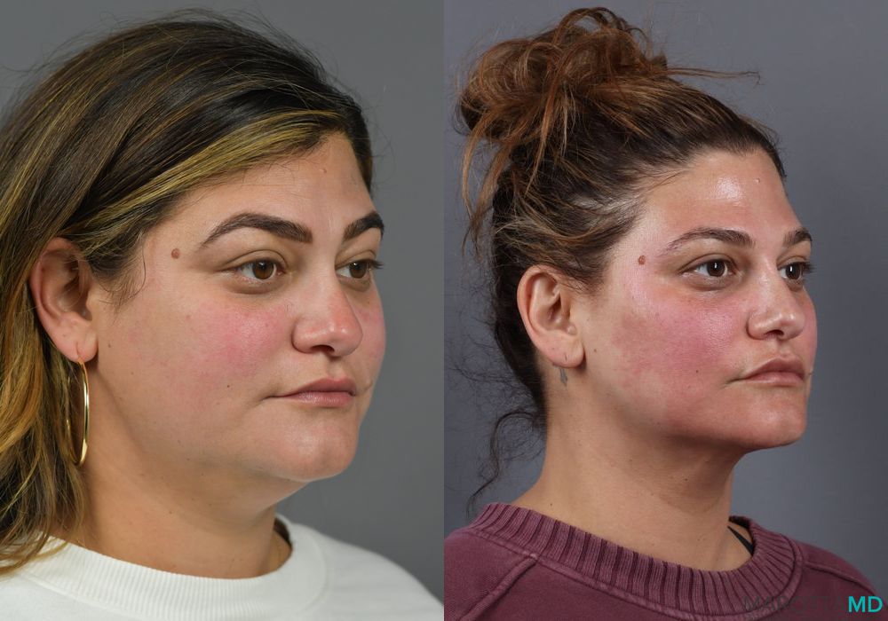 Liposuction of the Neck - Case 226