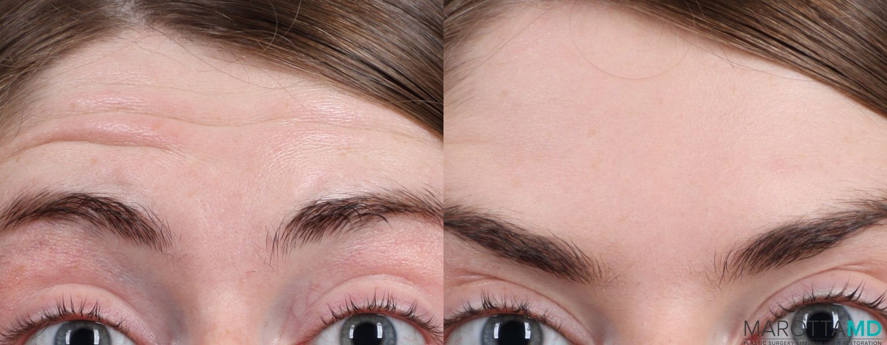 Before and after Botox - Forehead case 7177 - Angle 2