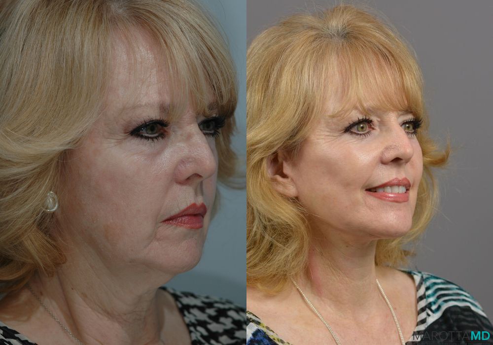 Laser Skin Resurfacing - Face - Thumbnail 3