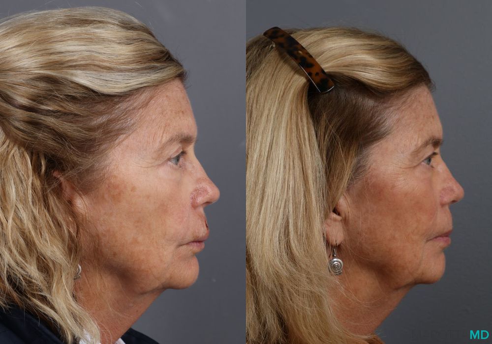 Skin Cancer Reconstruction - Face - Thumbnail 2