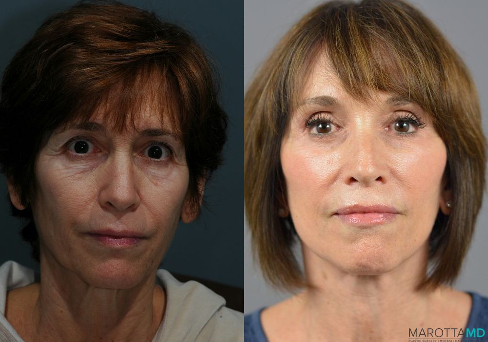 Facelift & Neck Lift - Thumbnail 4