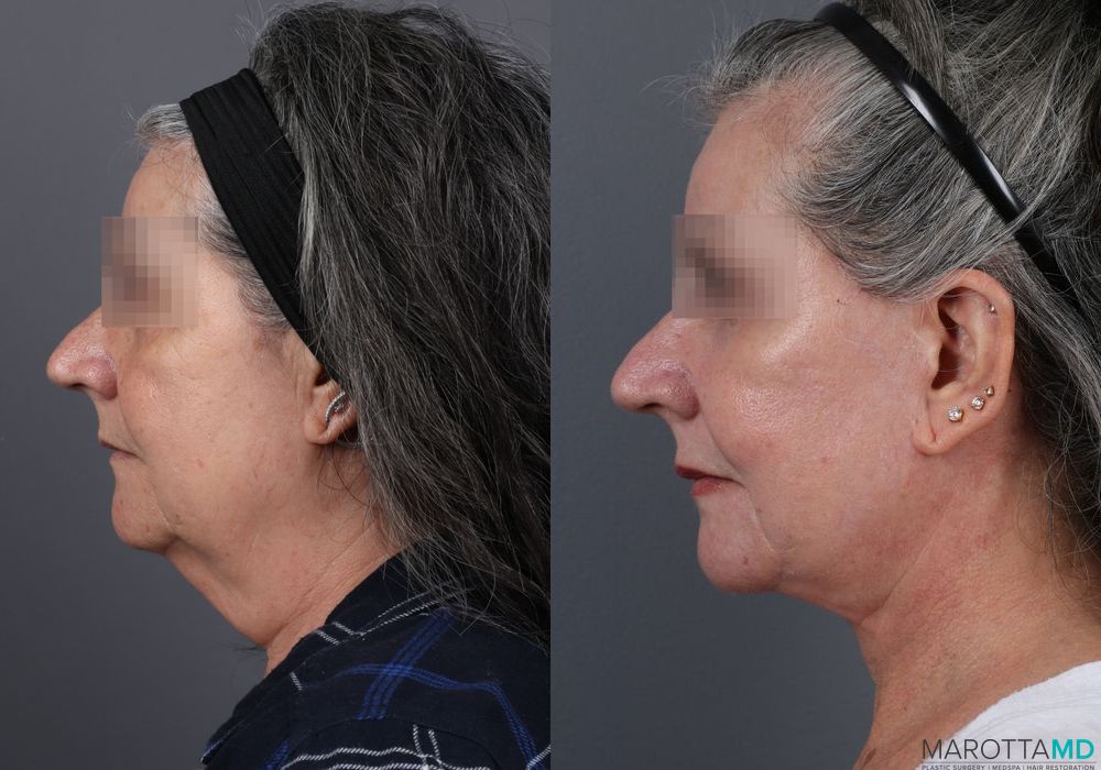 Laser Skin Resurfacing - Face - Thumbnail 3