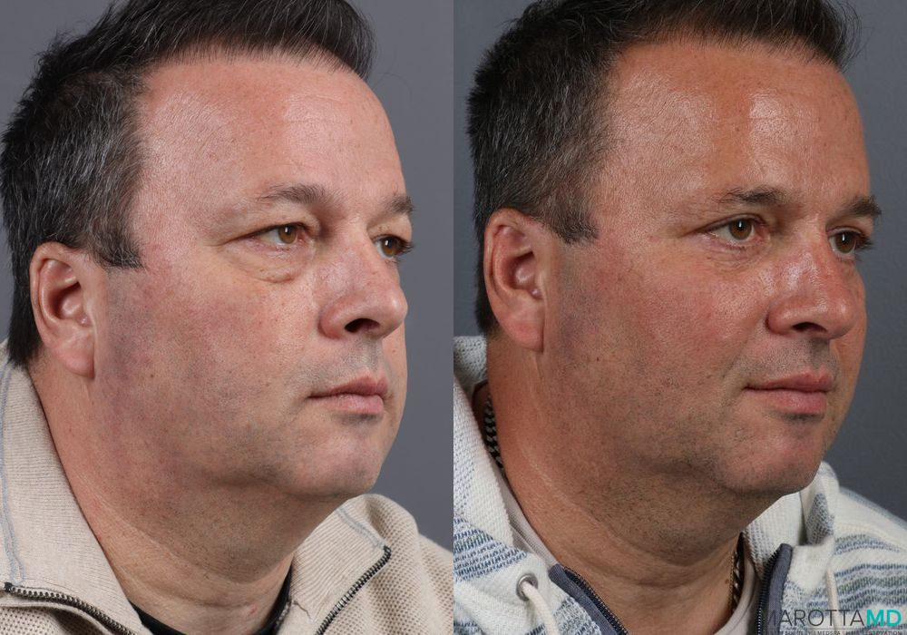 Blepharoplasty - Thumbnail 2