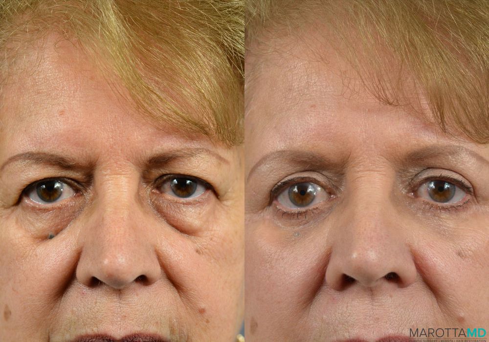 Before and after Blepharoplasty case 7007 - Angle 3