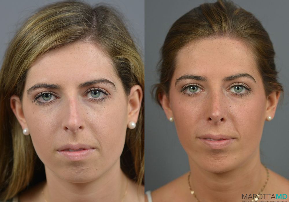 Rhinoplasty - Case 262