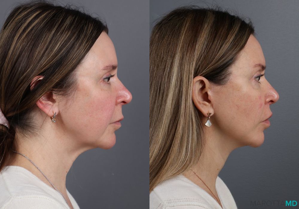 Facelift/Mini Facelift - Thumbnail 5