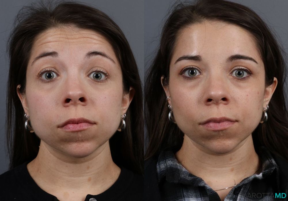 BOTOX® Cosmetic - Case 380