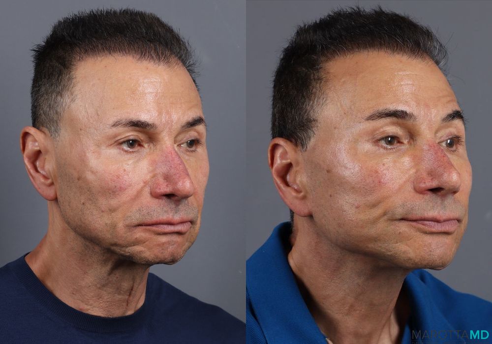 Before and after Facelift & Neck Lift case 7115 - Angle 2