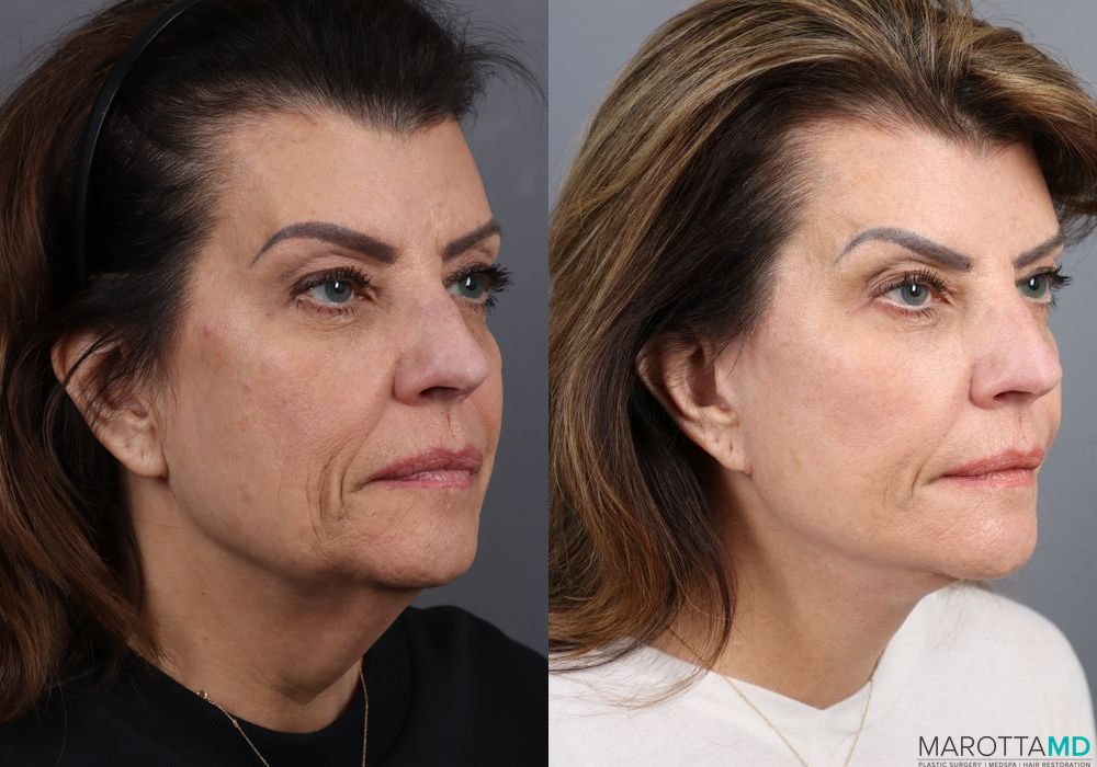 Facelift & Neck Lift - Thumbnail 2