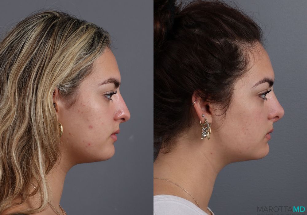 Before and after Rhinoplasty case 7250 - Angle 3
