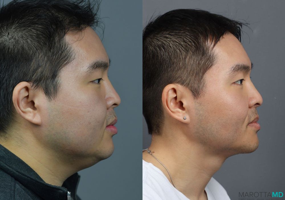 Buccal Fat Removal - Thumbnail 2