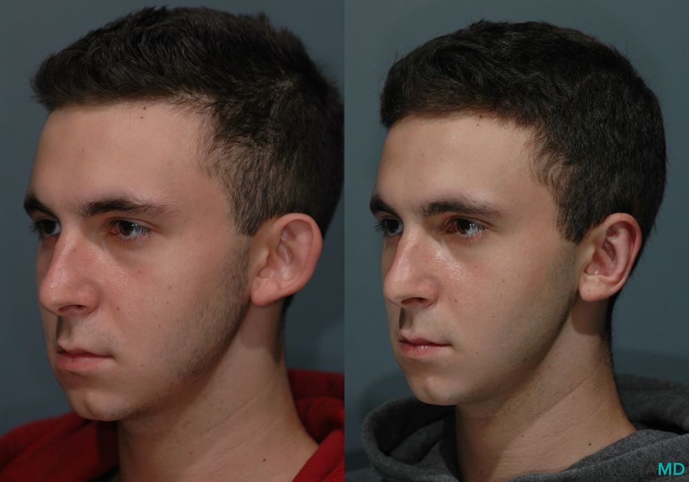 Otoplasty - Case 240