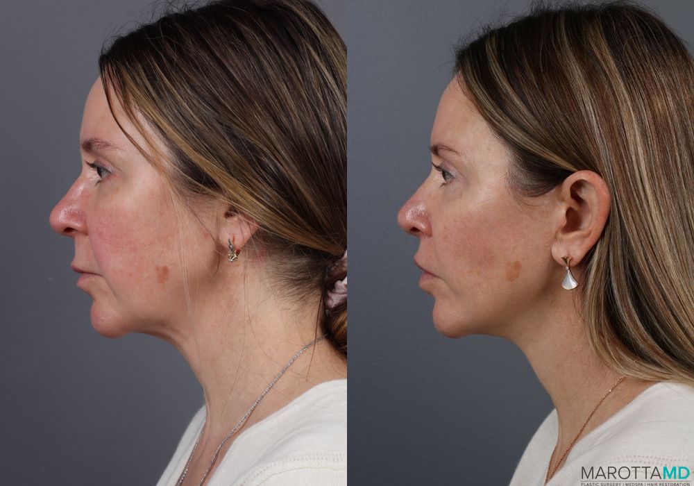 Facelift/Mini Facelift - Thumbnail 4