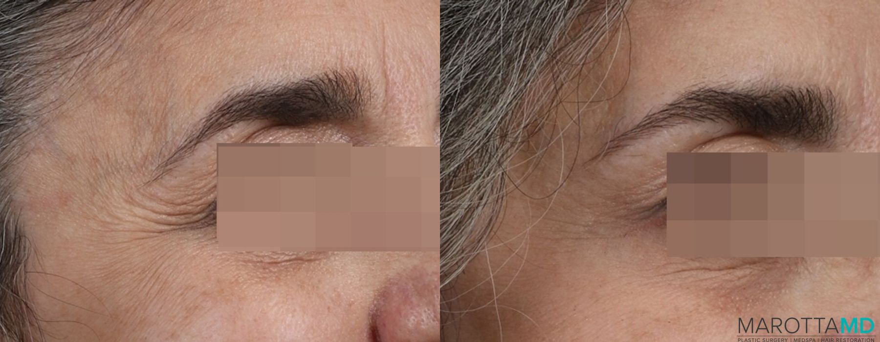 Before and after Botox - DAO case 7154 - Angle 5