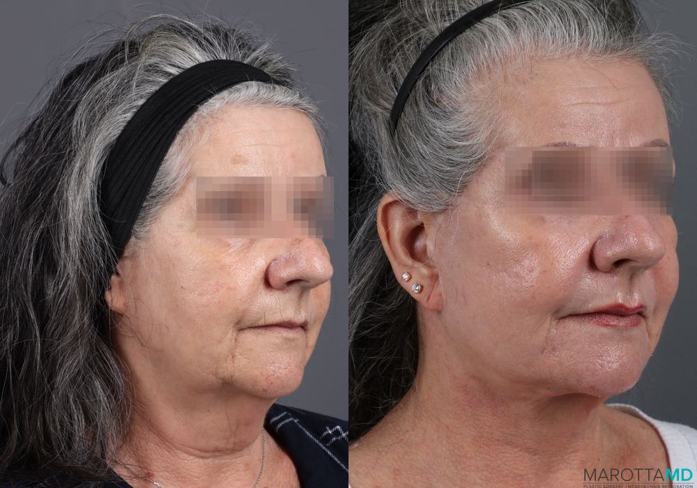 Laser Skin Resurfacing - Face - Thumbnail 5