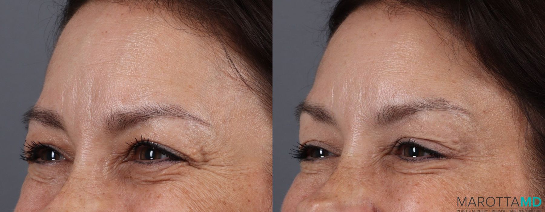 Botox - Forehead - Thumbnail 2