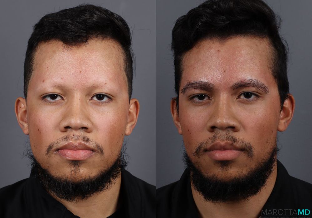 Hair Transplantation - Thumbnail 2