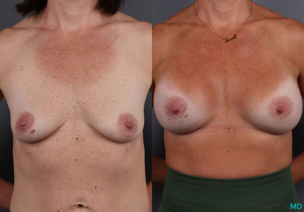 Before and after Breast Augmentation case 7083