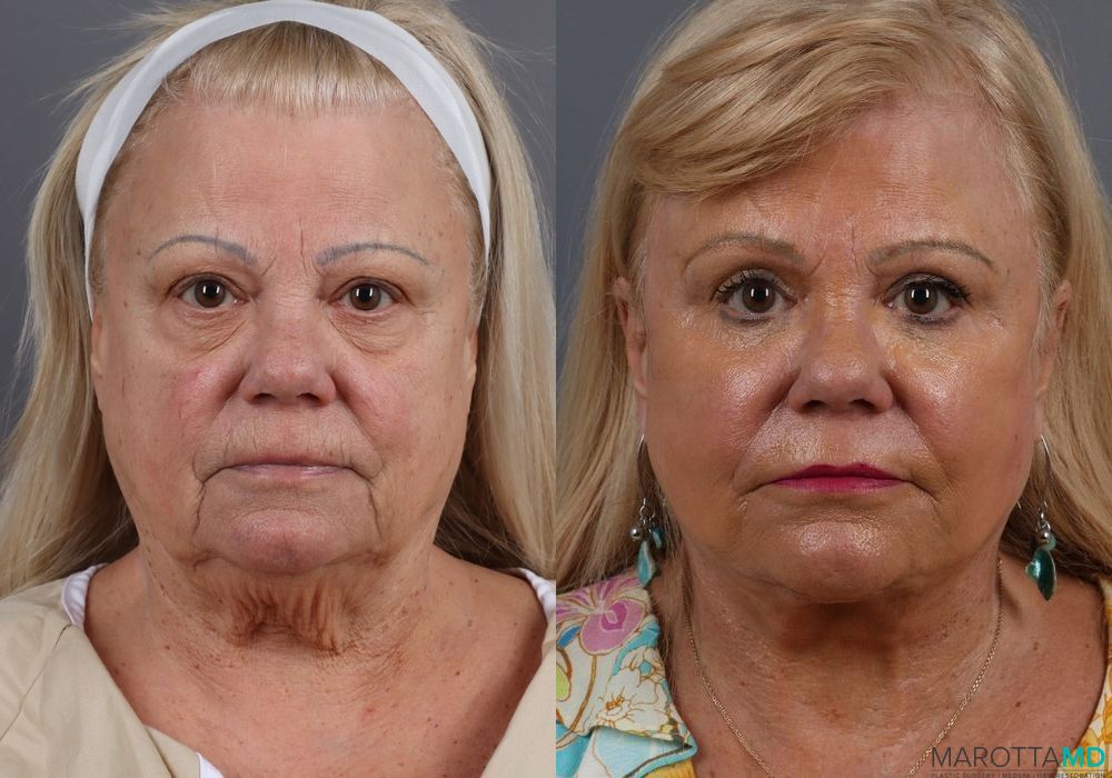 Laser Skin Resurfacing - Face - Case 218