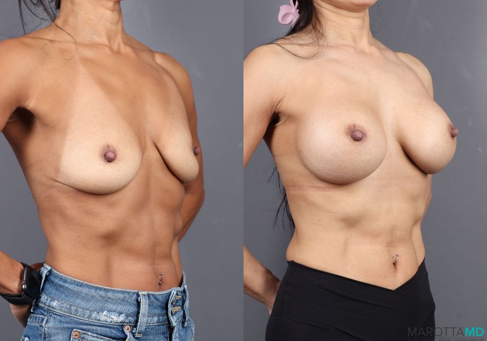 Breast Augmentation - Thumbnail 2