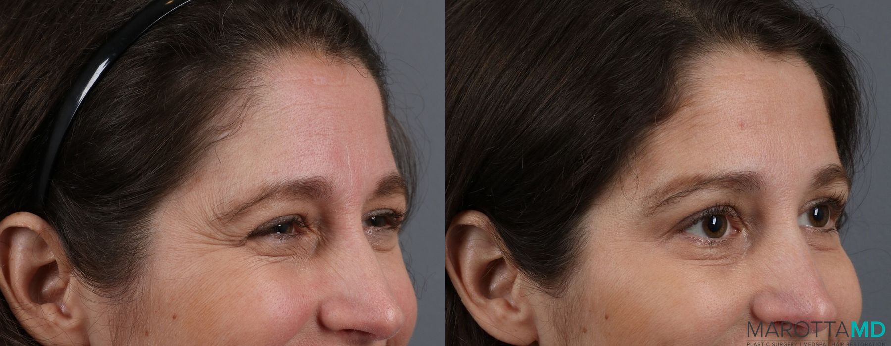 Before and after Botox - Crow's Feet case 7167 - Angle 3