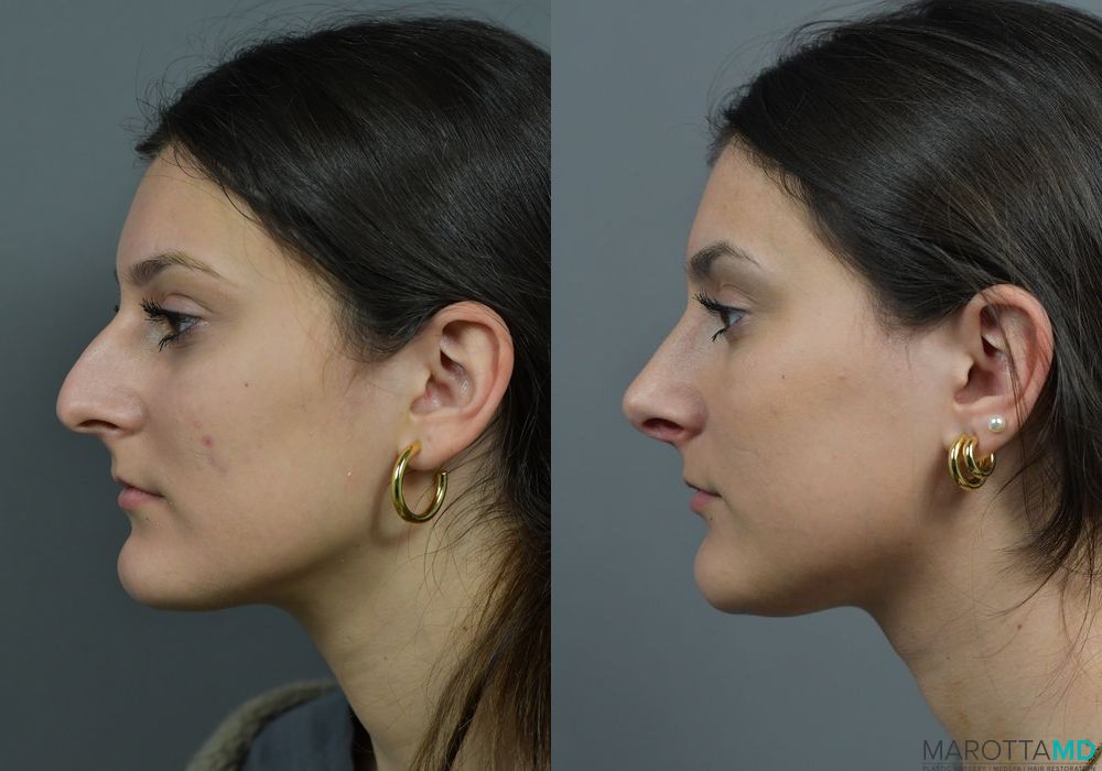 Before and after Rhinoplasty case 7283 - Angle 5
