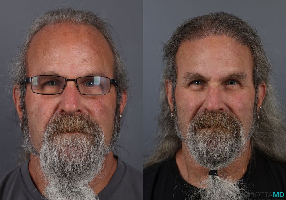 Hair Transplantation - Case 282