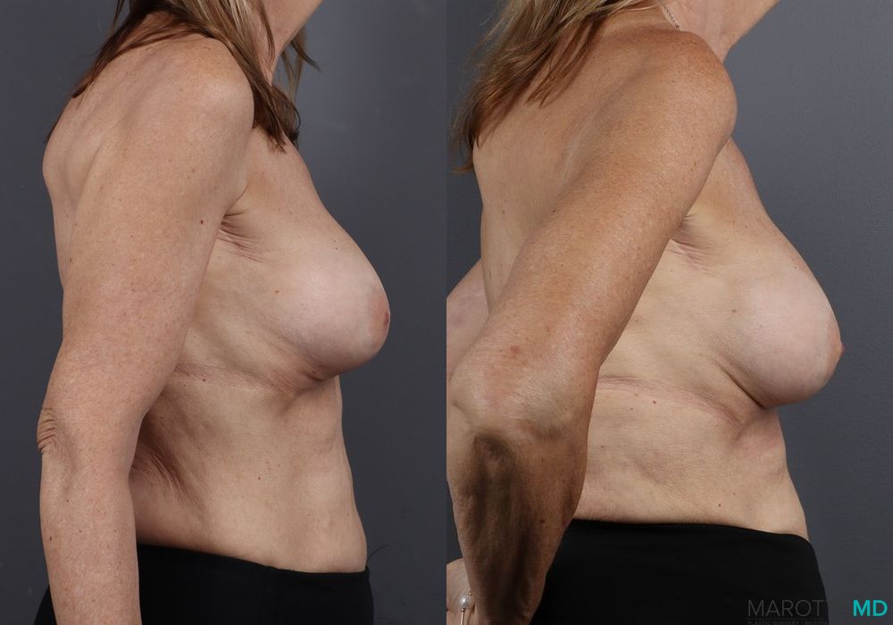 Before and after Breast Implant Exchange case 7245 - Angle 3