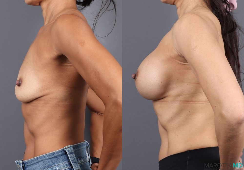 Breast Augmentation - Thumbnail 4