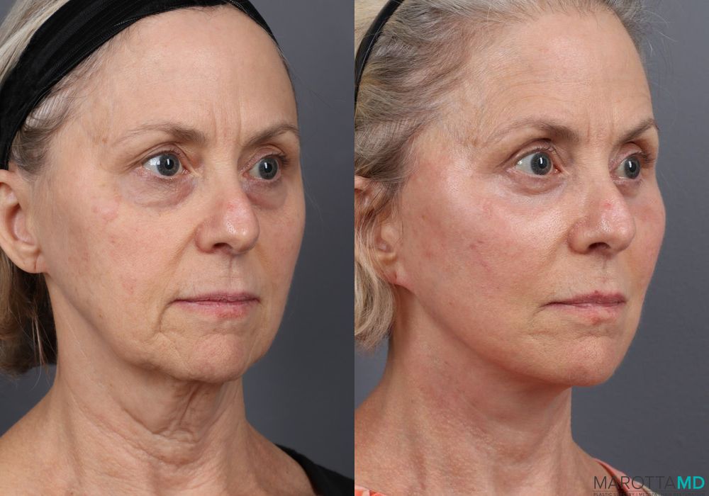 Before and after Facelift & Neck Lift case 7087 - Angle 3