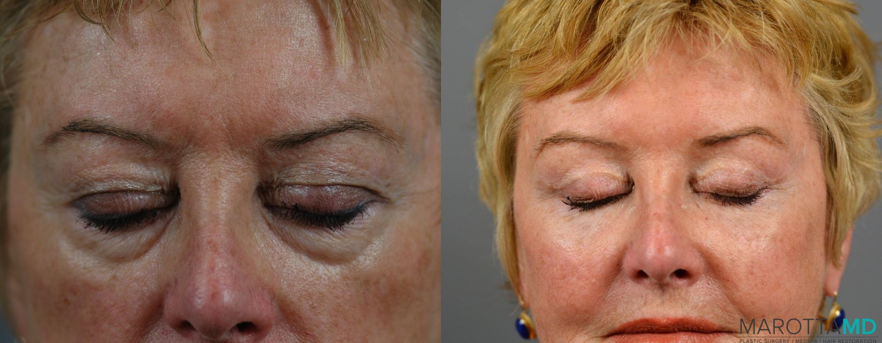 Blepharoplasty - Thumbnail 5